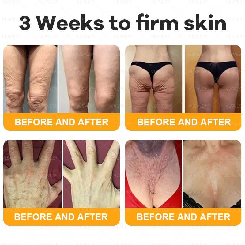 Made and Shipped from UK 💖VLSVLS® Bee Venom Comprehensive Cream  LAST DAY 80% OFF (Suitable for all ages)